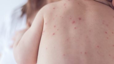 SSA informa de 980 casos de varicela en el estado